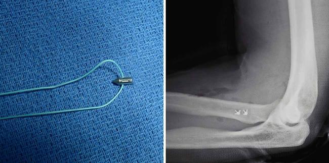 A common surgical option is to attach the tendon with stitches through holes drilled in the radius bone.