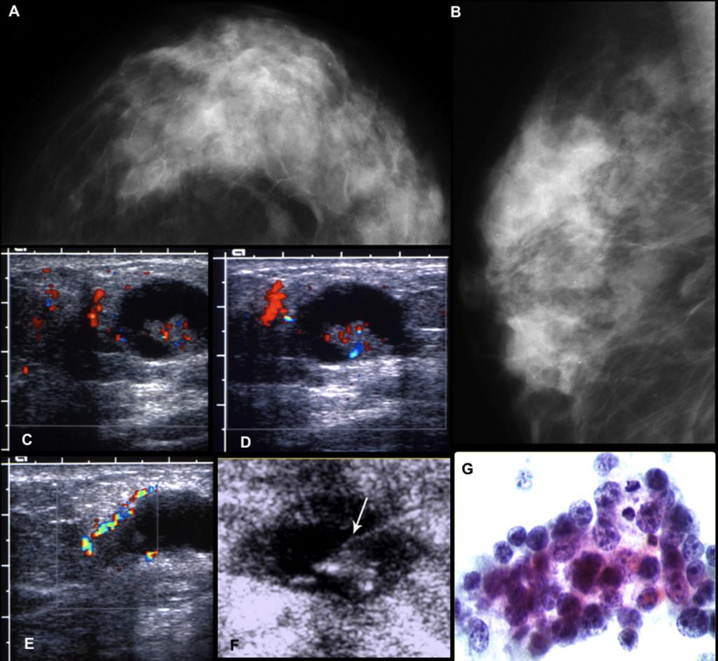 Fig. 1: A,B. Craniocaudal and mediolateral oblique mammograms depict dense breasts with asymmetric formations and summation shadows. C-E.