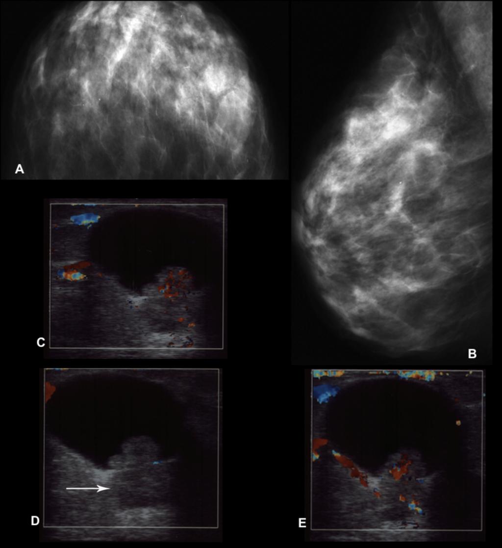 Fig. 2: A, B. Craniocaudal and mediolateral oblique views of a fatty breast with residual fibroglandular tissue in upper outer quadrant. C,D.