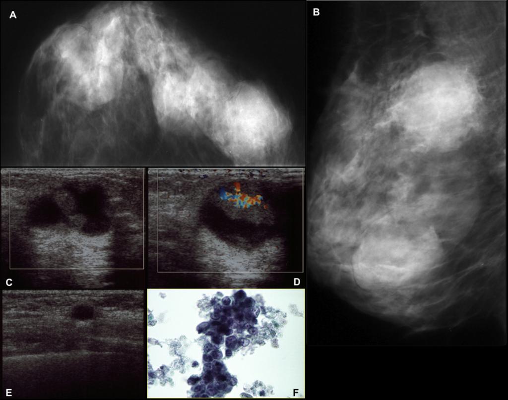 Fig. 4: A,B. Mammography demonstrates multiple high-opacity masses that are rather circumscribed, compatible with cysts. C,D.