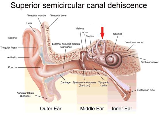 Dehiscence of the bony canal (= third window on the labyrinth) (Rare) Symptoms: - Conductive hearing loss (air-bone gap) - Vertigo attacks provoked by pressure / loud noise, lasting for few minutes