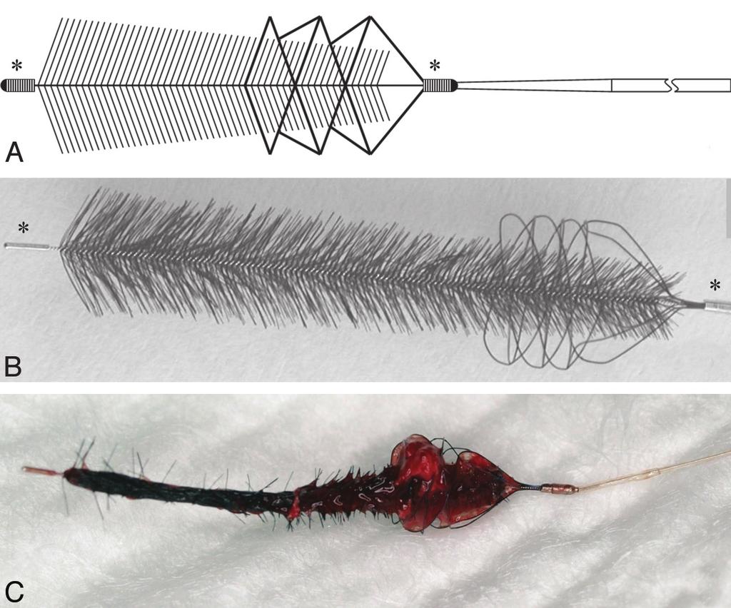 Fig 1. Graphic illustration (A) and photograph (B) of the Phenox CRC device. The core wire compound holds radially oriented polyamide microfilaments trimmed in a conical, brushlike shape.
