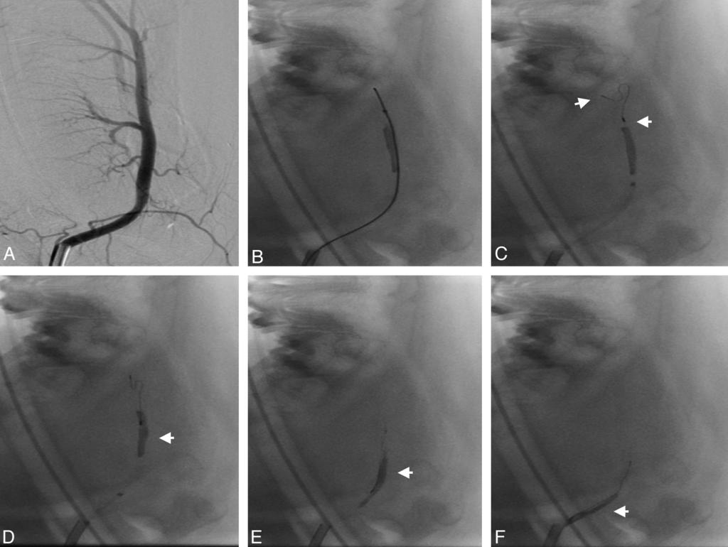 Fig 2. Angiogram of the lingual artery before embolization (A). Passing of the microcatheter and microwire between thrombus and the vessel wall (B).