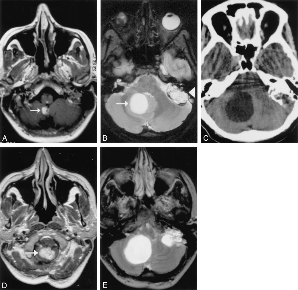 AJNR: 24, September 2003 HEMANGIOBLASTOMA 1571 FIG 1. Images in a patient with a solid cerebellar tumor that progressed to enlarging cysts with the subsequent development of symptoms.