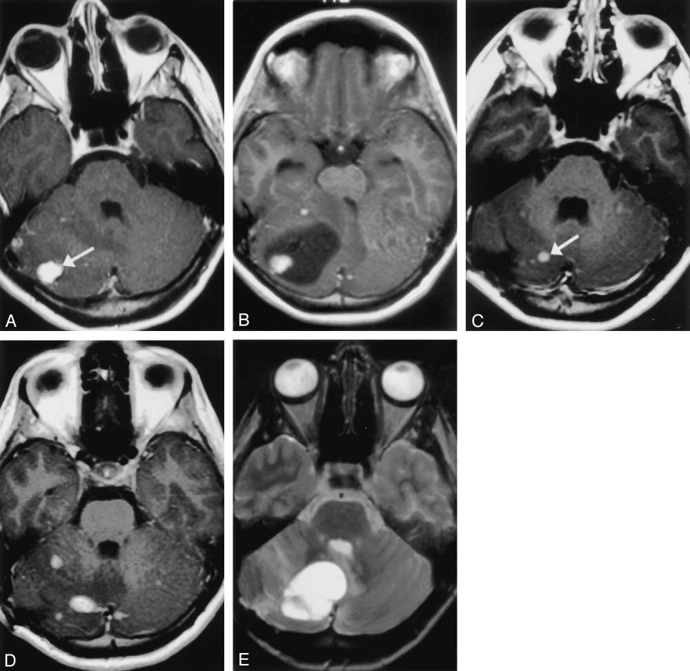 1572 SLATER AJNR: 24, September 2003 FIG 2. Images in second patient with a solid cerebellar tumors that progressed to enlarging cysts with the subsequent development of symptoms.