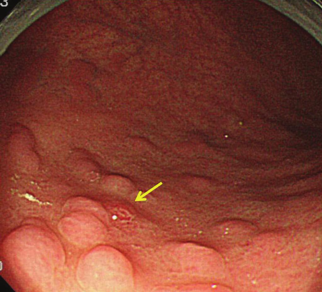 (a) 3 (b) (c) (d) Figure 2: (a) Conventional endoscopic findings in Case 3. Yellow arrow shows a nodule with redness.