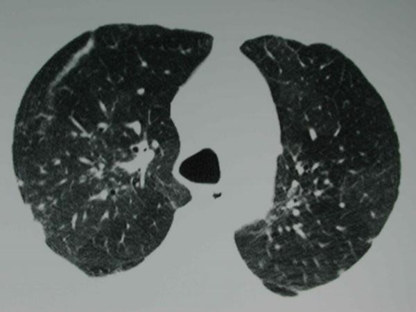 Hypersensitivity Pneumonitis-Key Points ART-associated Pulmonary Disease 1.