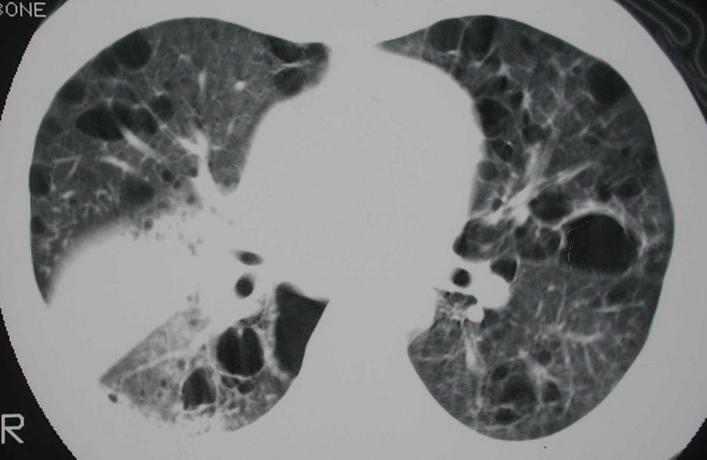 Case 10 A. Tuberculosis (TB) B. Cryptococcal Pneumonia C. Endemic Fungal Pneumonia D.