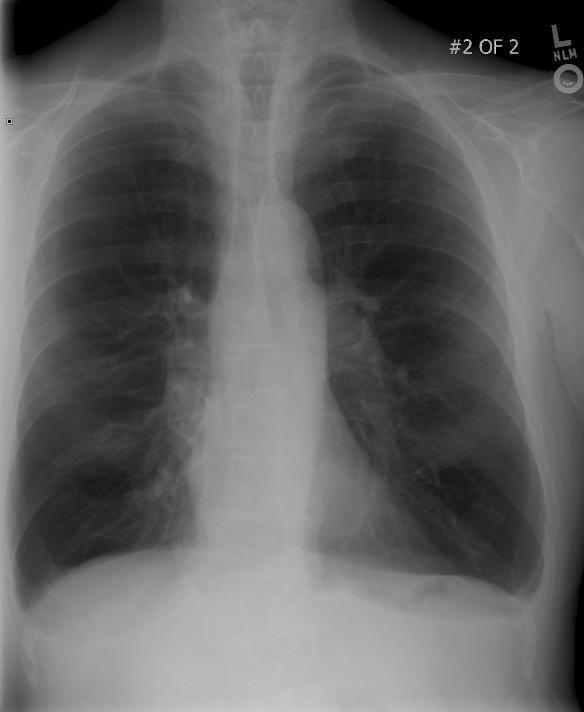 Case 3 A. Bacterial pneumonia B. Pneumocystis pneumonia (PCP) C. COPD/emphysema D.