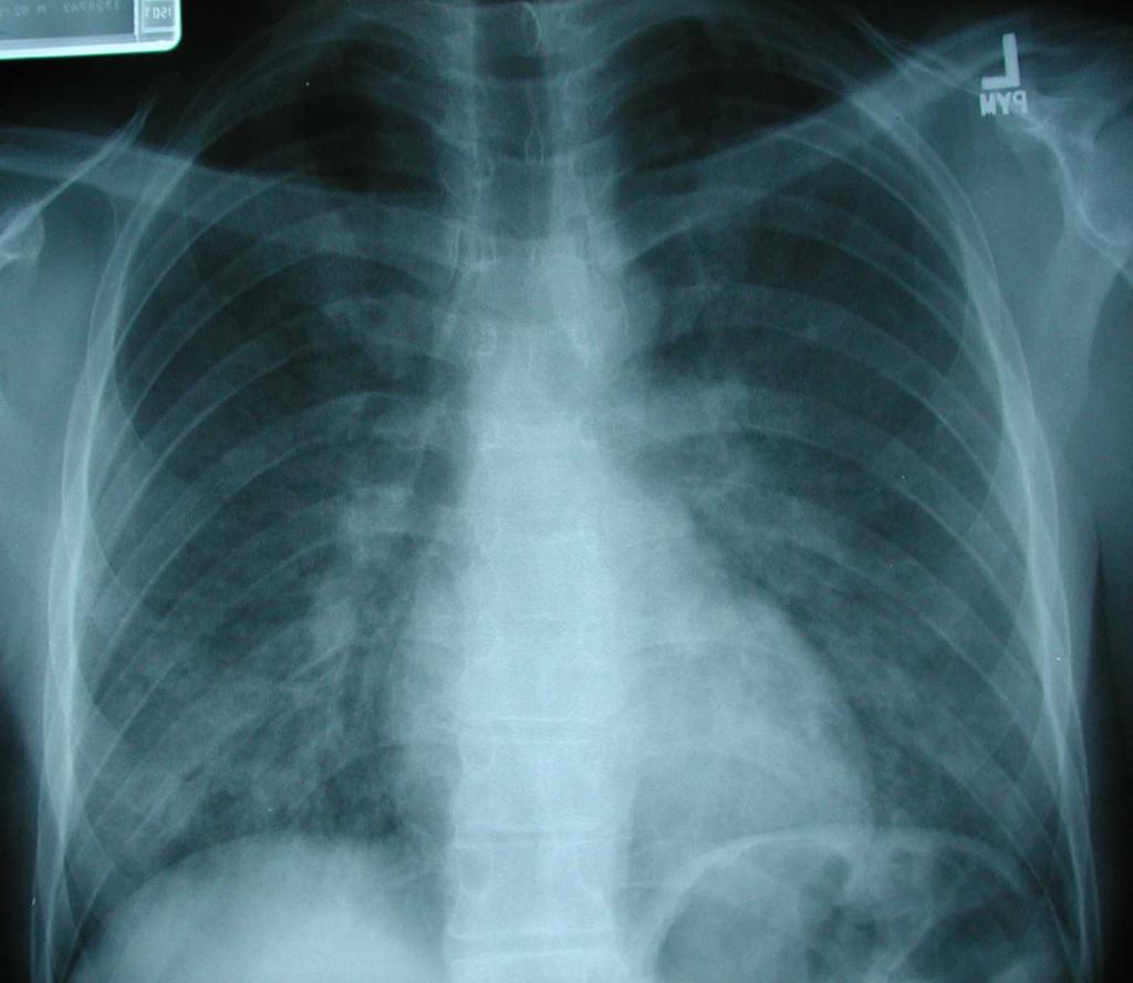 Case 4 Case 4 CD4 = 100 cells/µl 3 weeks of fever, cough (non-productive), and dyspnea Lungs Bilateral inspiratory crackles Heart Tachycardic, no