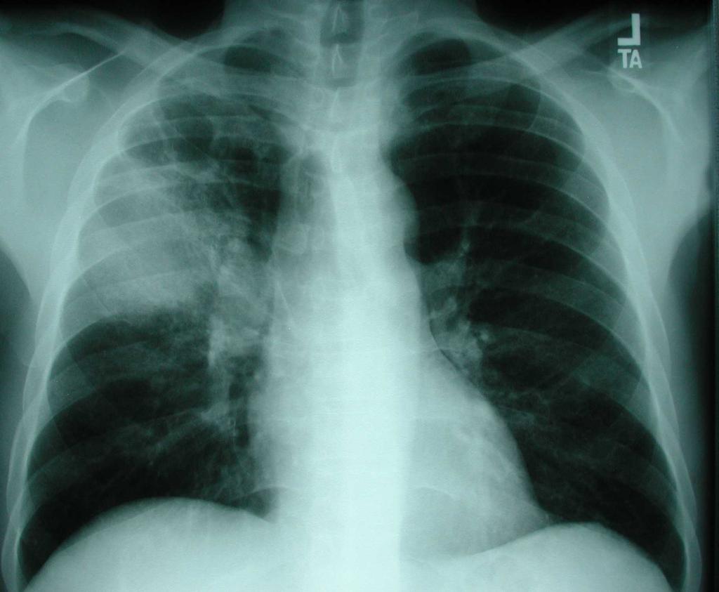 out (significant) pulmonary KS. 2.