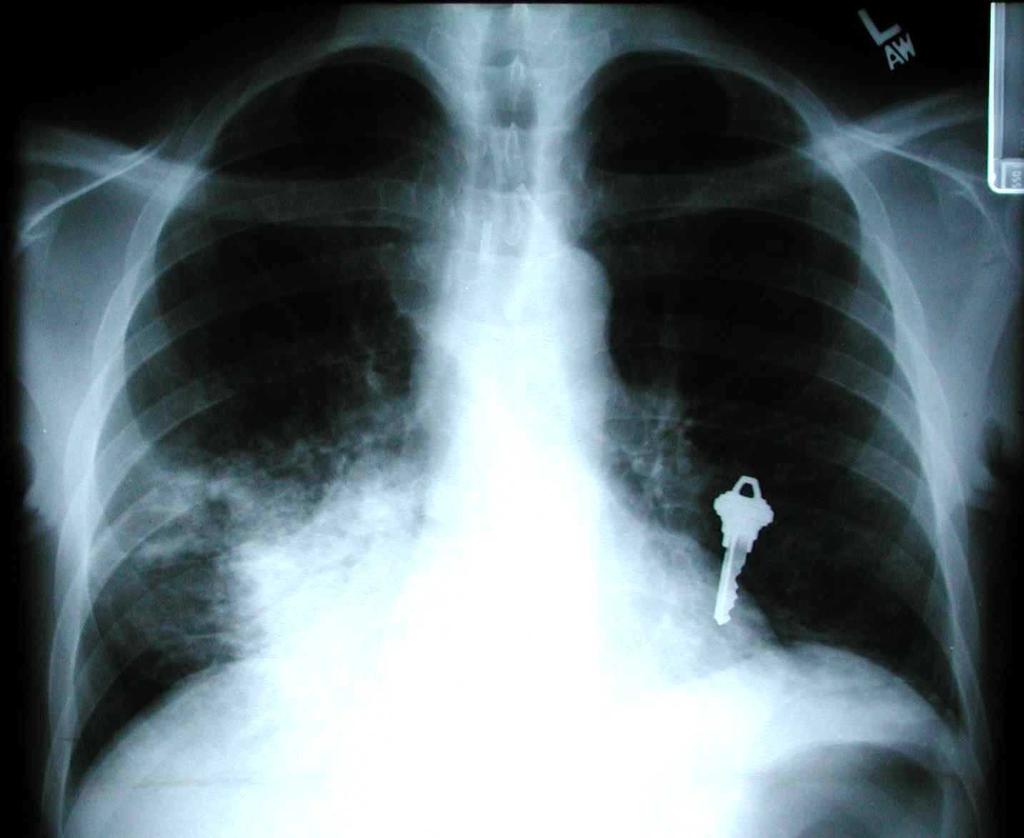 A. Tuberculosis (TB) B. Cryptococcal Pneumonia C. Endemic Fungal Pneumonia D.