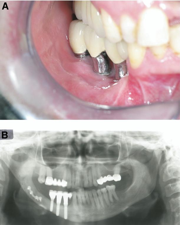 CASE 2 A 41-year-old female patient who had an ameloblastoma on the right side of the mandible was reconstructed by using free vascularized fibula flap after resection.