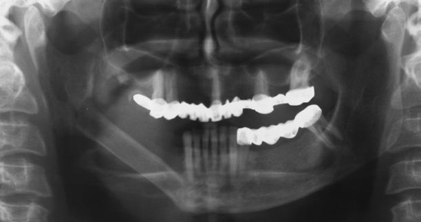 However, there was a vertical discrepancy between fibula and the unaffected dentate side because of insufficient height of the fibula, which could jeopardize the longterm success of implants.