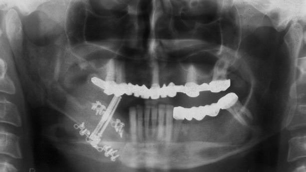 A box-shaped osteotomy was done using a sagittal saw and osteotomes on the vestibular aspect of the reconstructed mandible, and the green stick fracture was achieved on the lingual side with chisels.