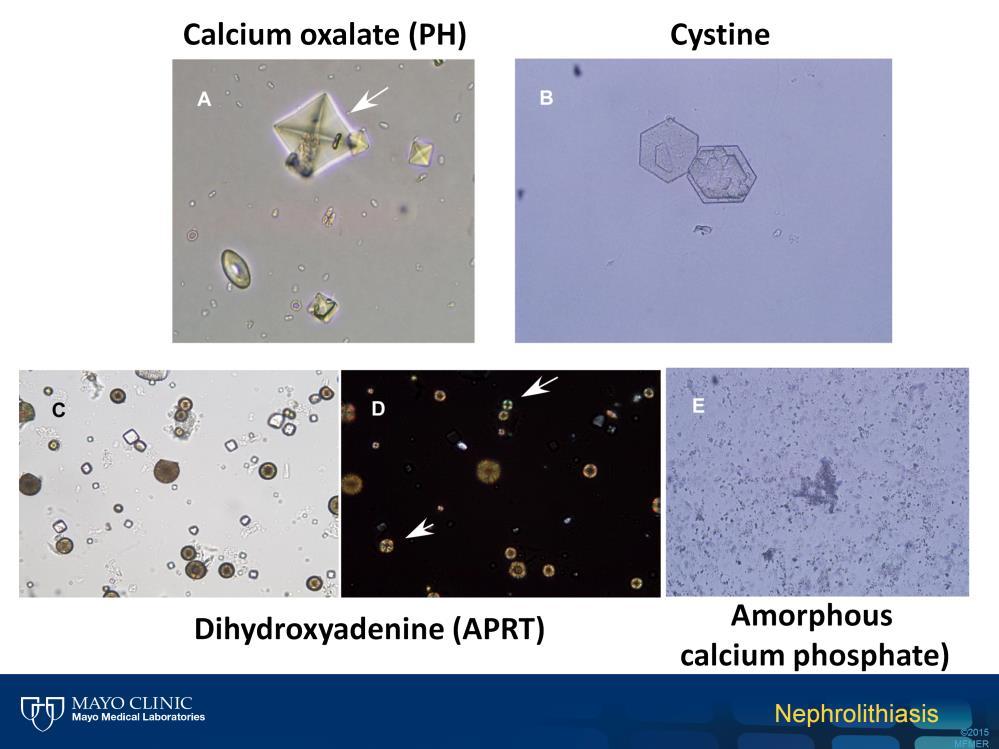 Shown on this slide are typical calcium oxalate dihydrate, cysteine, and DHA crystals.