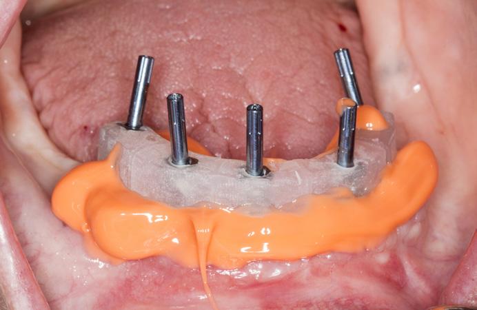 Inject impression material under and around the jig to capture the ridge and all anatomical landmarks as for a full denture including full vestibular extensions and the complete