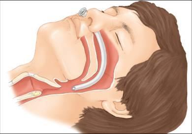 Airway Adjuncts Nasopharyngeal airways useful in pts with airway obstruction or those at risk for