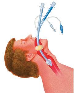 Esophageal-Tracheal Tube Advantages: Isolation of airway Reduced risk of aspiration More reliable ventilation Ease of training