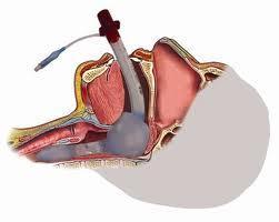 Laryngeal Tube Advantages: same with Combitube PLUS more