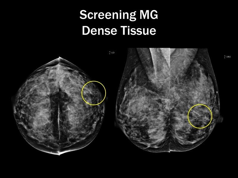 Digital Breast Tomosynthesis Increases detection of cancer by 35% Decreases callbacks by 15-30% Increased false positives for ultrasound compared to decreased false positives for tomosynthesis
