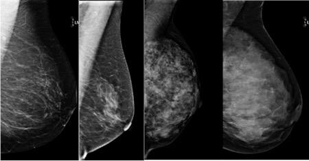 Breast Density Ratio of fat to fibroglandular tissue in the breast.