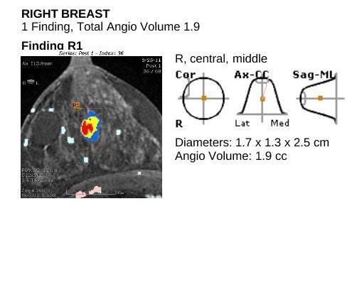 1. Masking Surrounding breast tissue obscures a cancer. G. Boyd, H Guo et. al.
