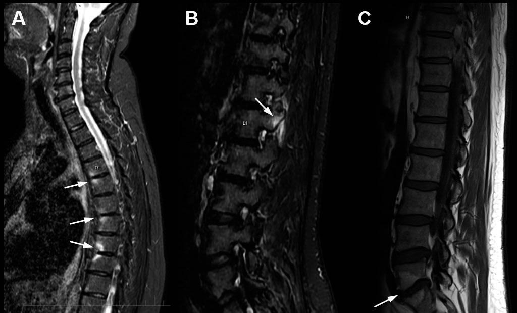 Figure 1. Anterior spondylitis (1A), STIR image showing corner bone marrow oedema at T4/5, T6/7 and T8/9.