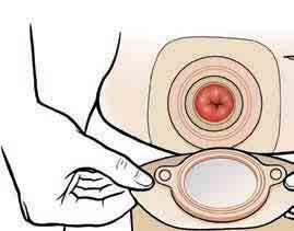 Put On the New Pouch Size and cut the barrier opening if needed (see page 9). Slowly peel the backing off the barrier. Carefully place the barrier over the stoma.