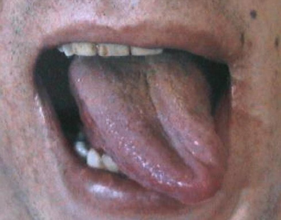 HYPOGLOSSAL NERVE (XII) - ALL MUSCLES OF TONGUE - SOMATIC MOTOR GENIO- GLOSSUS INTACT DAMAGE HYPOGLOSSAL NERVE ON ONE SIDE GENIO-