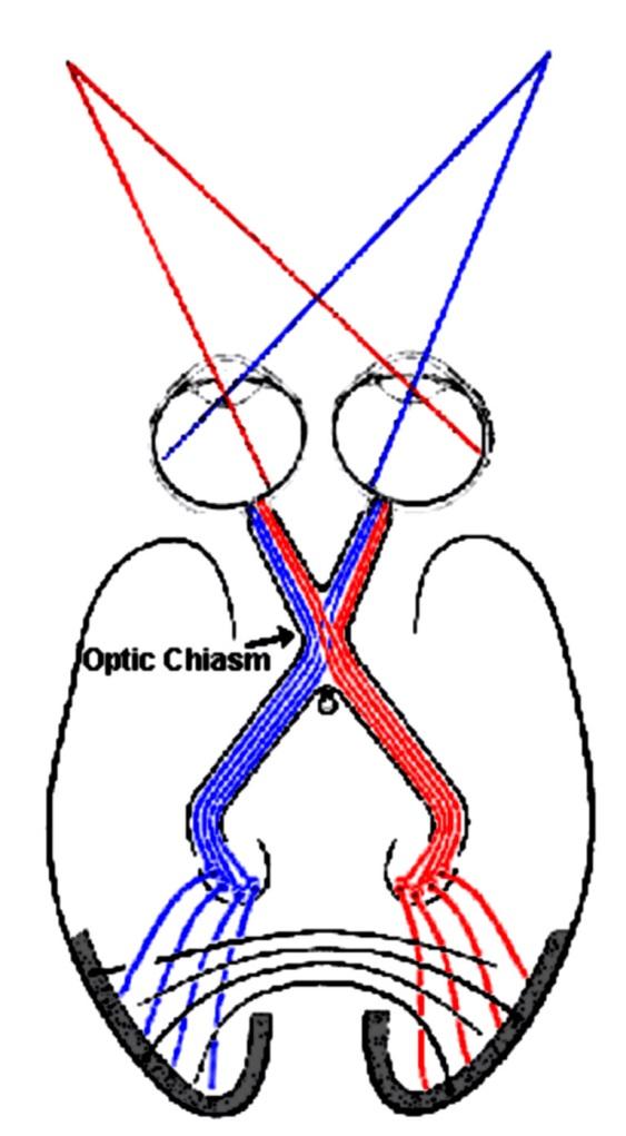 chiasm Retina DAMAGE OPTIC NERVE: loss of vision in one