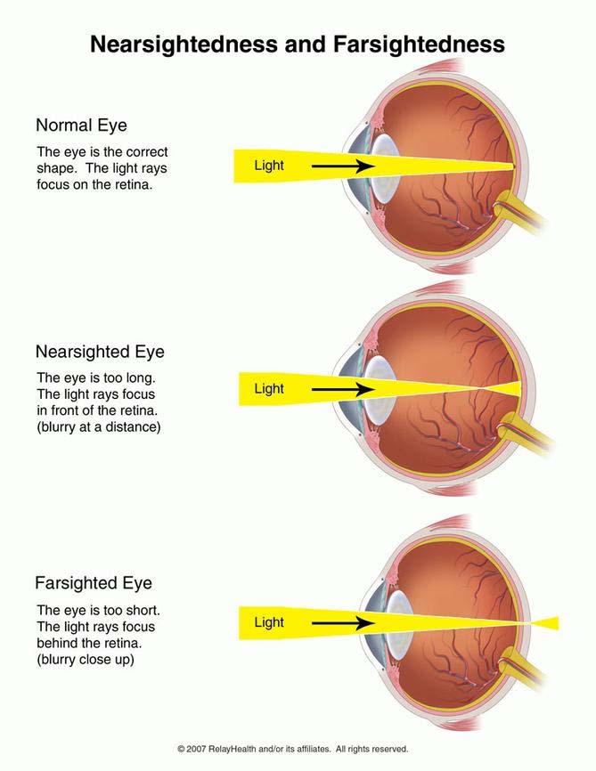 Visual Impairments Cataracts is the