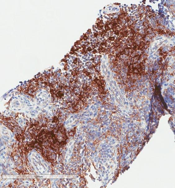 NKTR-214: Conversion of PD-L1(-) to PD-L1(+) in Tumor Biopsies from Baseline to Week 3 Associated with Clinical Benefit Patient with Urothelial Carcinoma Baseline: PD-L1 Negative Week 3: PD-L1