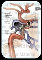 direction. A carotidcavernous fistula is one such communication, between the carotid artery and the cavernous sinus.