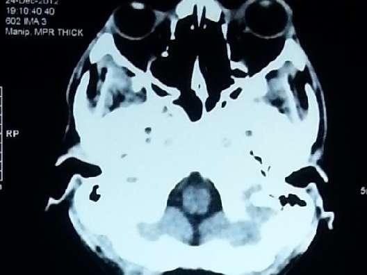 Investigations : CT brain. CTA brain.