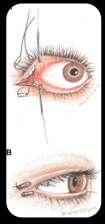 Treatment of the keratitis : Surgical Lt. Lateral Tarsorrhaphy. Medical Rt.