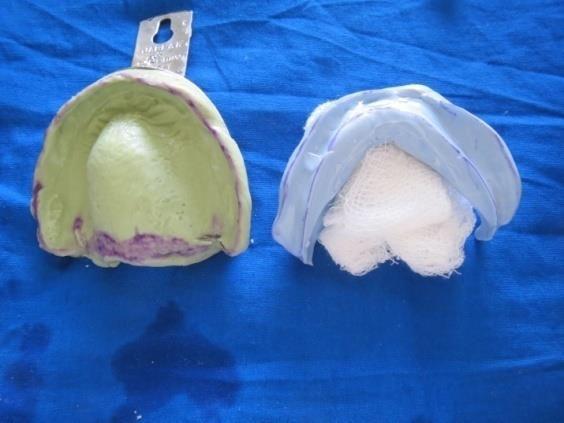 e) Waxing and sealing of the other half of sectional prosthesis was carried out, ensuring complete