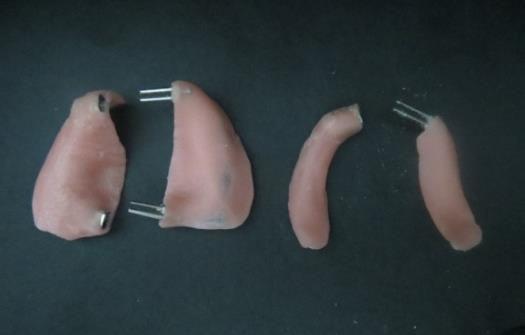 Sectional prosthesis insertion (Figure 7) After ensuring fit and stability of the sectional prosthesis,