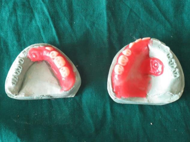 [8] Some authors have described the method of fabricating only the collapsible denture while others have described only sectional.