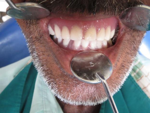 outside the mouth is a useful technique to adopt for such patients.