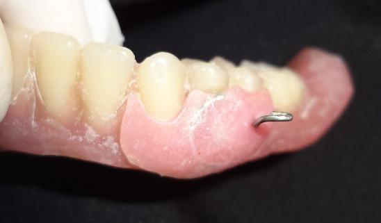 The availability of well-formed edentulous ridges and an excellent peripheral seal permitted excellent retention and stability of the dentures, and the presence of the