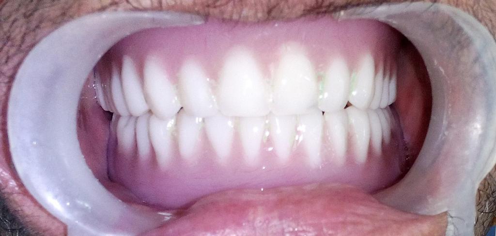 Close mouth technique requires the use of a well-fitted maxillary recording base, accurate occluding rims, and an acceptable vertical dimension. 5.