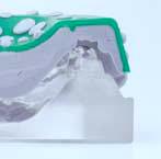 3 Studies have shown that most disposable plastic trays are too flexible to ensure accuracy, particularly when the two-stage putty/wash silicone