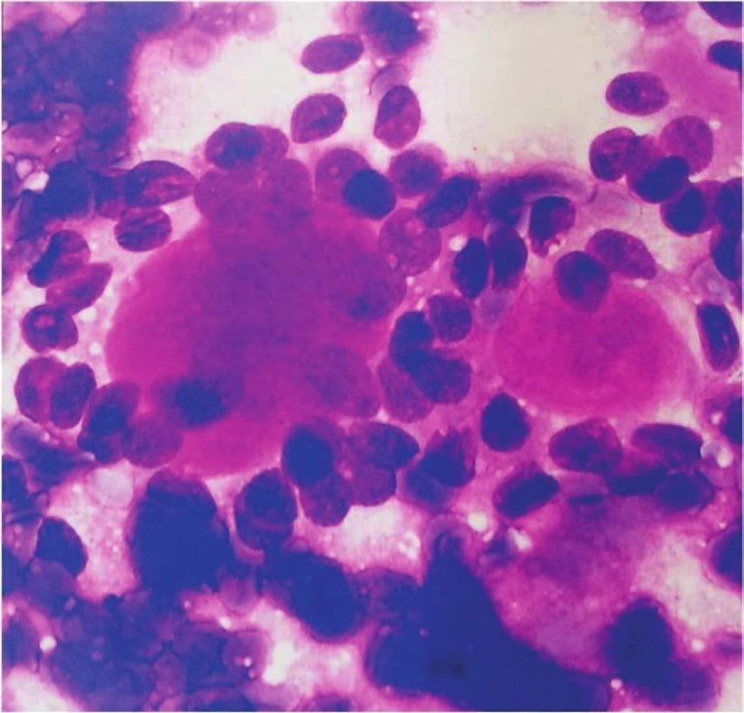 Individual cells have medium-sized, rounded nuclei and bland chromatin with abundant fine cytoplasm. (Papanicoloau, 100).