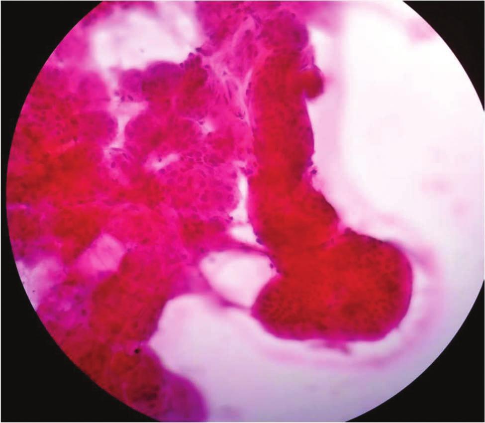 vacuolated cytoplasm in a background of pale-staining eosinophilic homogenous seromucinous material (Papanicoloau, 100).