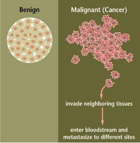 Malignant versus Benign Tumors Depending on whether or not they can spread by invasion and metastasis, tumors are classified as being either benign or malignant.