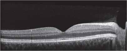 OCT Pearls for Glaucoma using OCT of the macula for glaucoma
