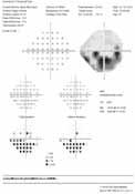 Visual Fields Structure-Function Left Eye Left Eye