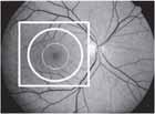 Why the image the macula for glaucoma? More neuronal loss in the macula before visual field changes are seen Why do you rob banks?