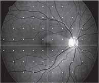 retina has 70% RGC loss Peripheral retina has 30-40% RGC loss. 32.... 44.... 49. 55....... 62 67..... 44... 69..... 44... 70........ 63 62.